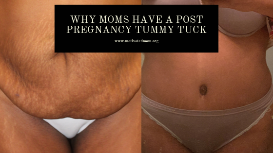 Why Moms Have A Post Pregnancy Tummy Tuck